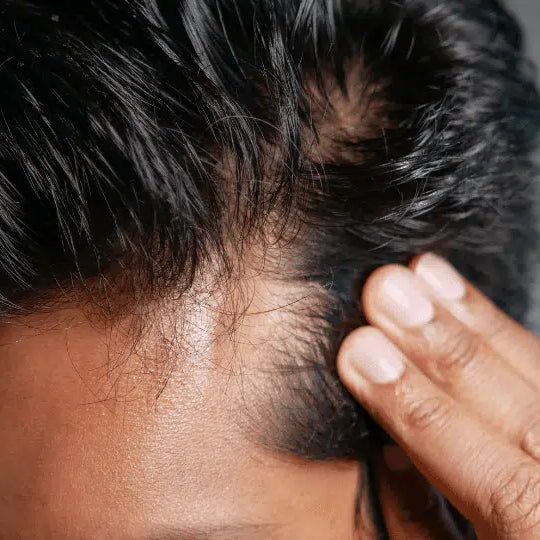 Ursachen für Haarausfall und natürliche Heilmittel